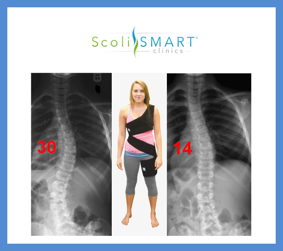 Adult Scoliosis Patients Find Hope With New Treatment