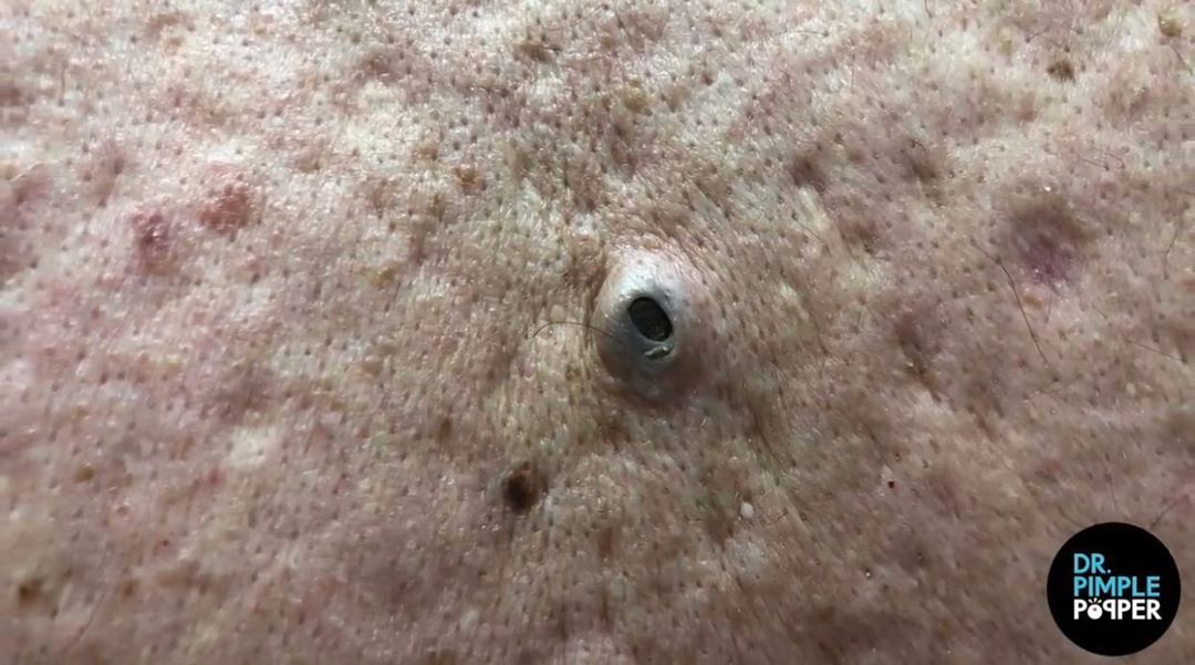 Dr. Pimple Popper See The KING Of All Blackheads Explode