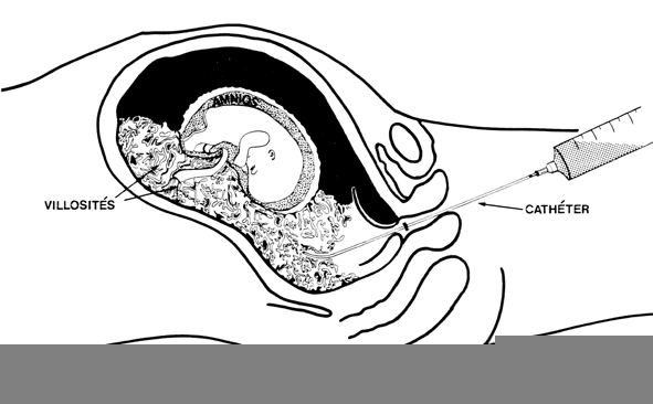 Génétique humaine Diagnostic anténatal