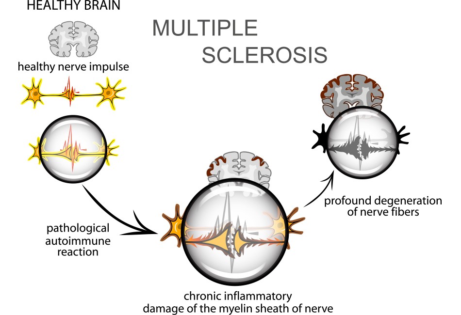 Multiple Sclerosis Medica Institute
