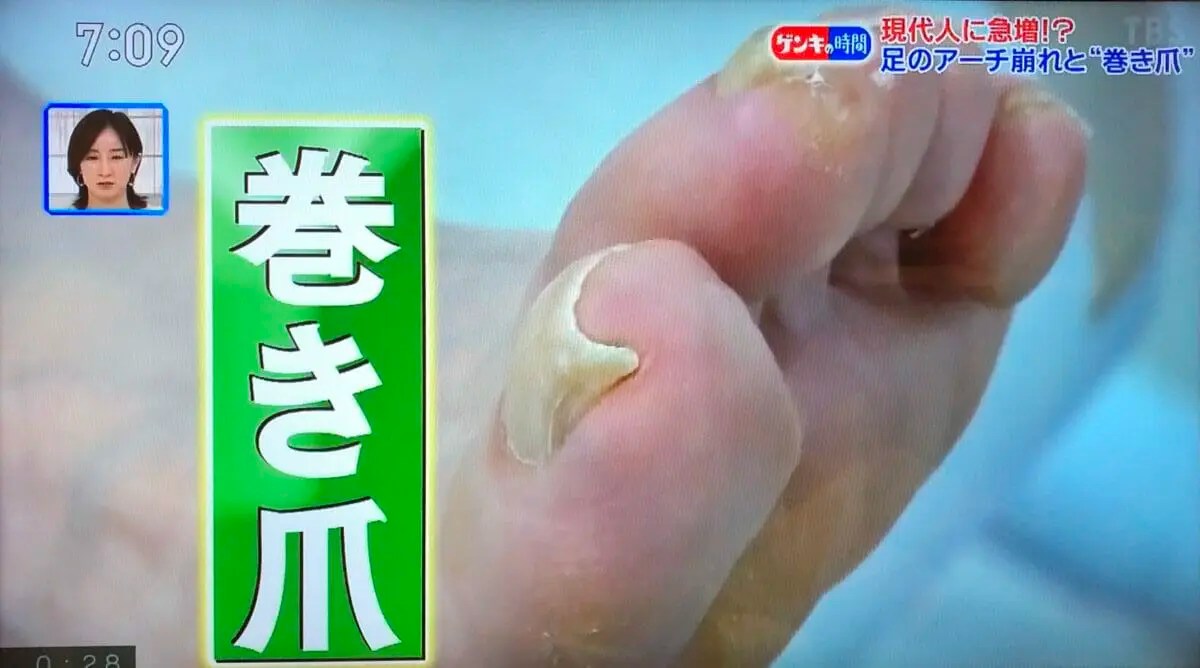 CBCテレビ（TBS系）「健康カプセル ゲンキの時間」でネイルエイドが紹介されました 【公式】専門医と学ぶ 巻き爪・陥入爪治療の相談室