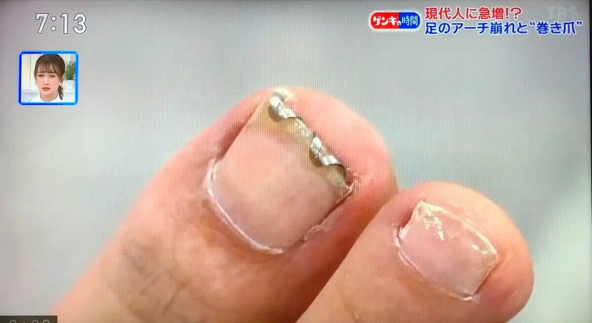 CBCテレビ（TBS系）「健康カプセル ゲンキの時間」でネイルエイドが紹介されました 【公式】専門医と学ぶ 巻き爪・陥入爪治療の相談室