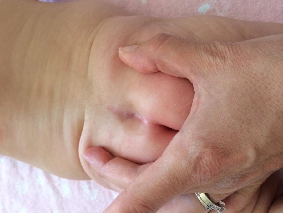 Sacral Dimple Pictures in NewBorn, Adults, Causes, What Is?, Treatment