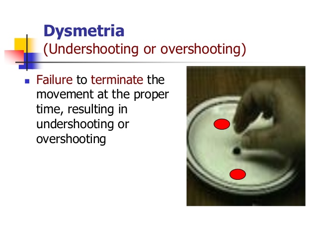Dysmetria Diagnosis (Test), Treatment, Causes, Symptoms