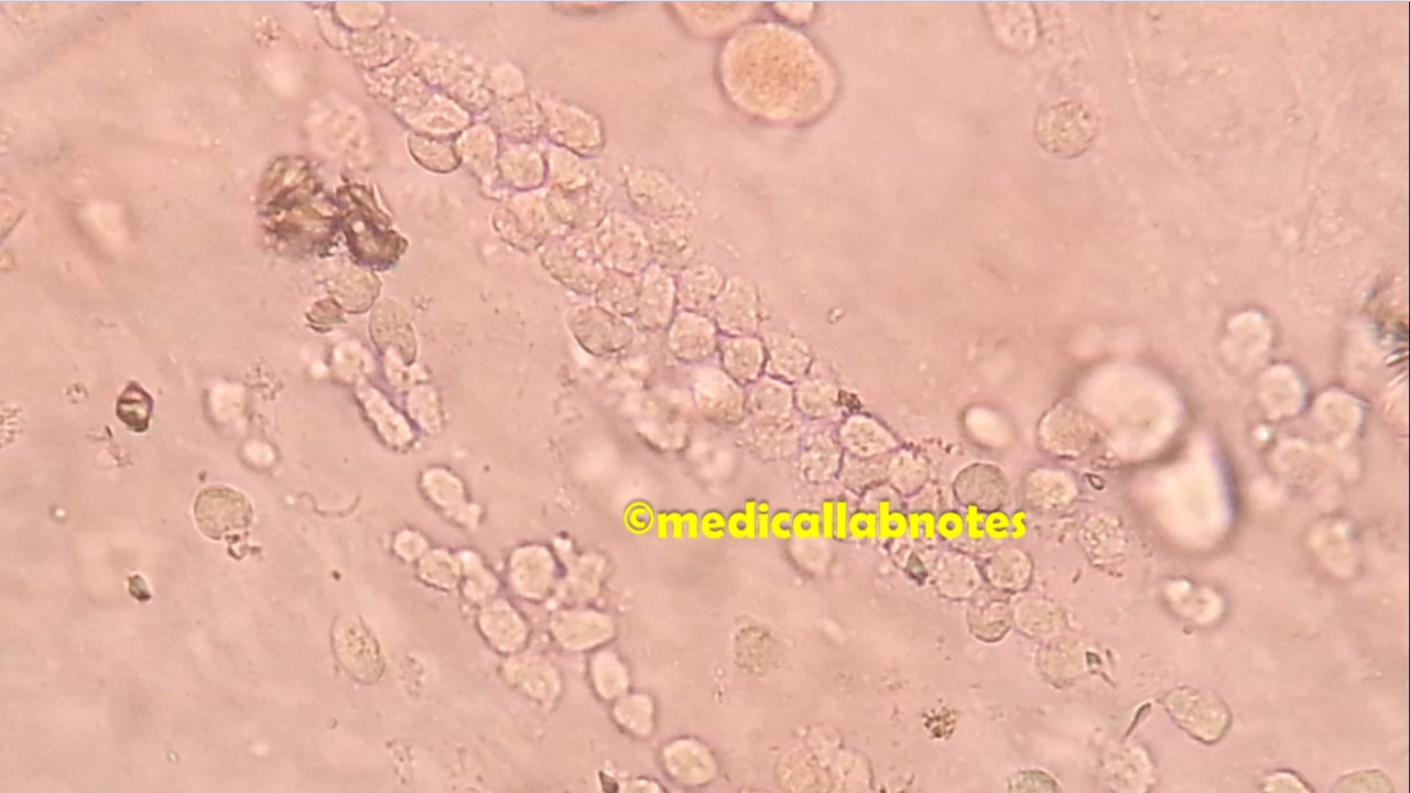 Urine Casts Introduction, Identification Features, and Clinical