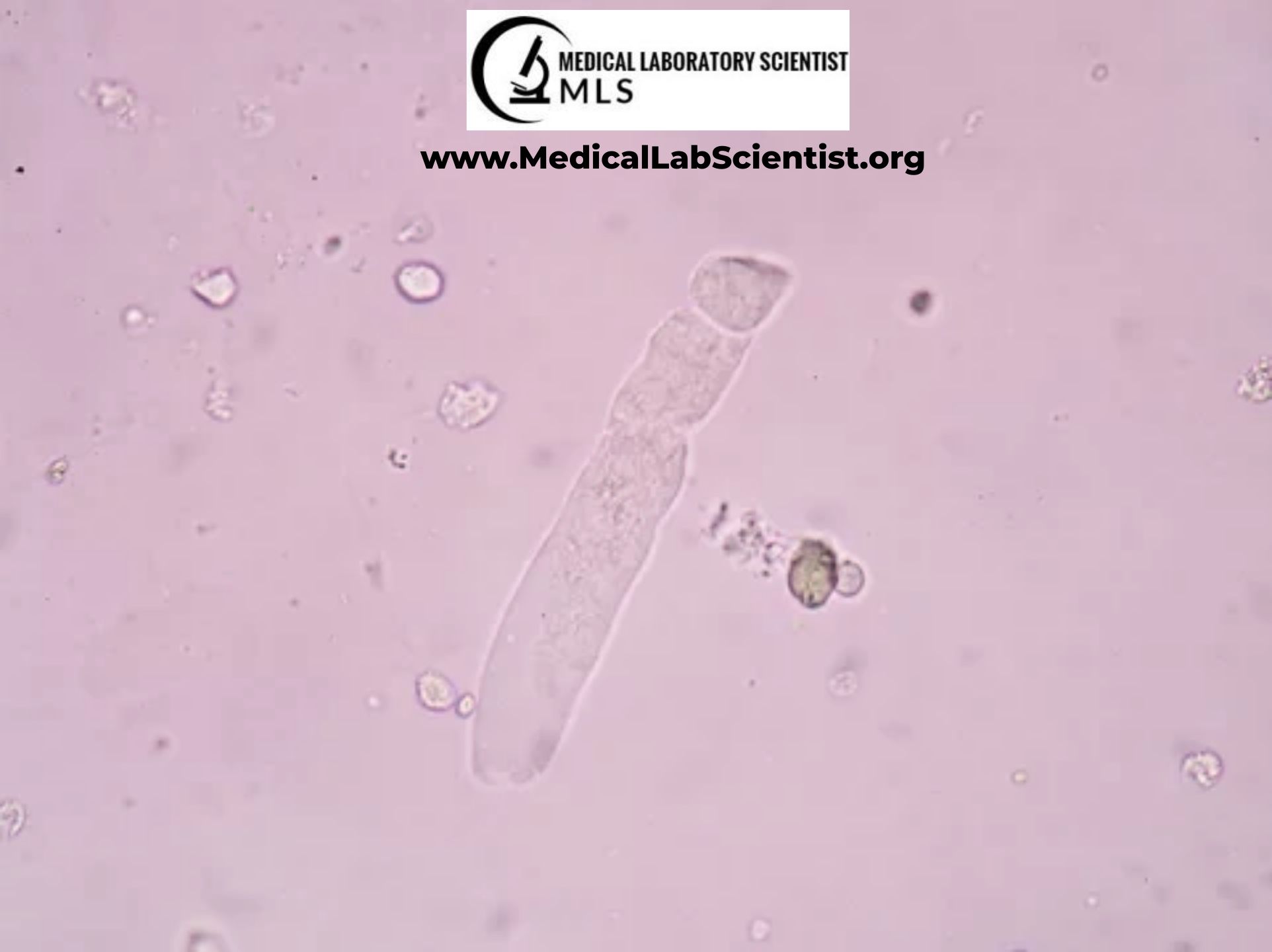 URINARY CASTS Types, Composition, Significance, Causes, Diagnosis