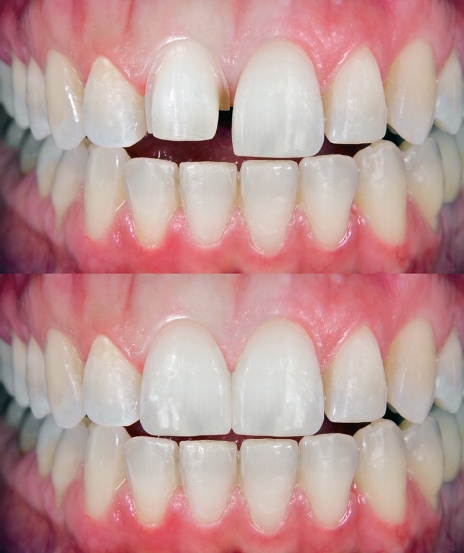 What are the benefits of veneers in Turkey? MedicaSmile