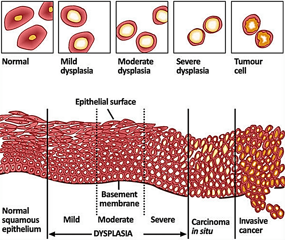 » Inflammation the Prerequisite to Disease 302