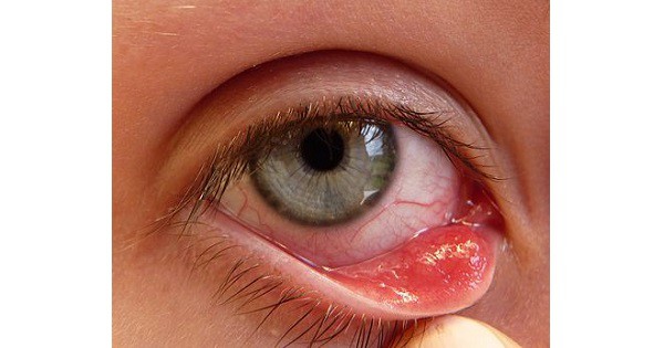 Sebaceous cyst - www.medicoapps.org