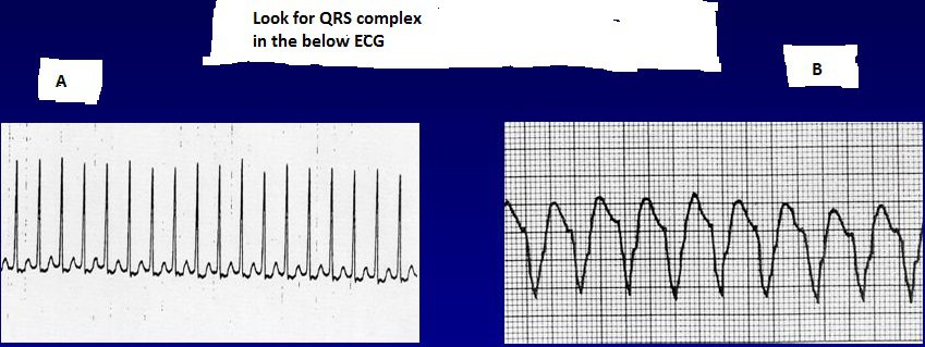 ECG Narrow QRS Wide QRS