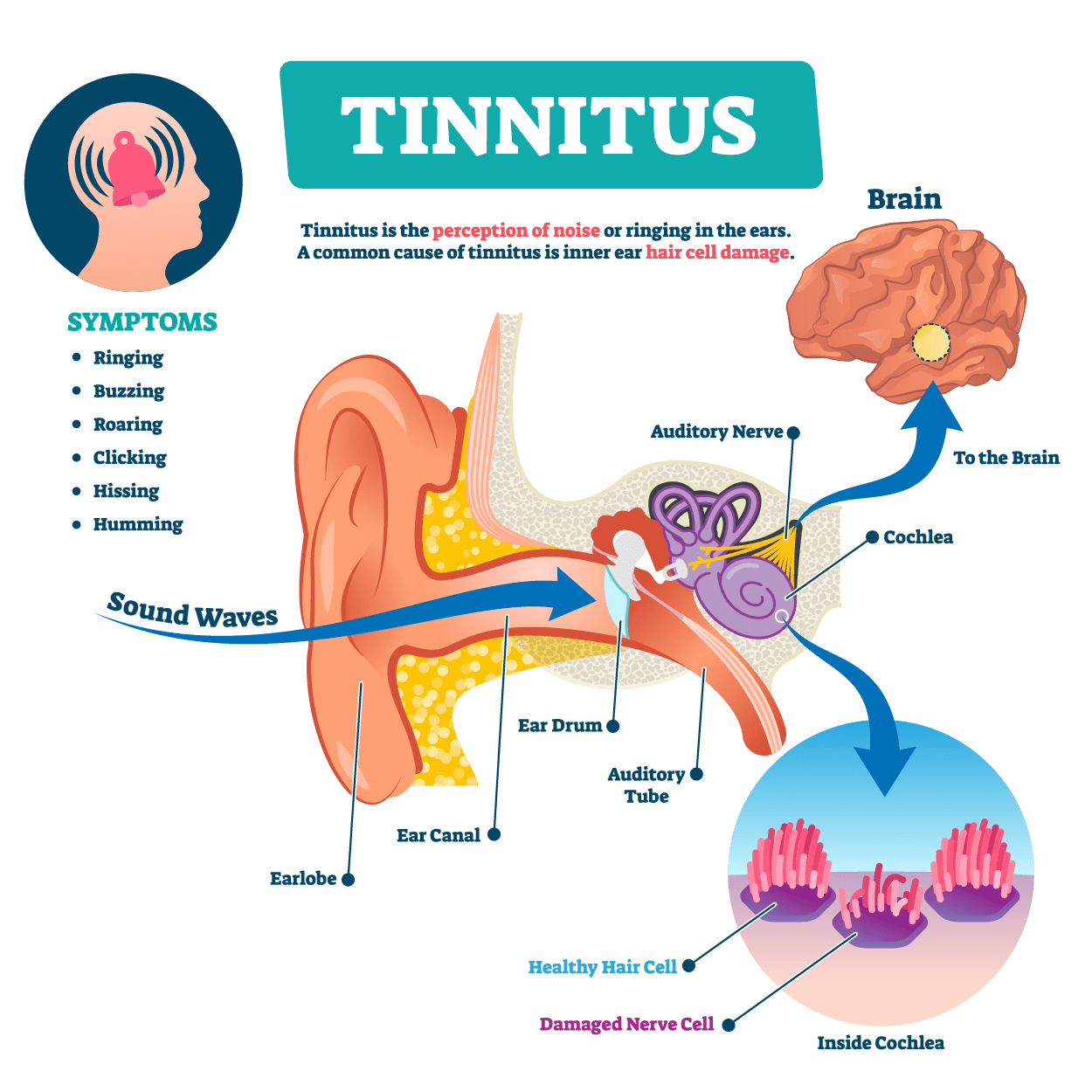 Tinnitus - Medicohelp | Infuustherapie Tegen Tinnitus In Duitsland