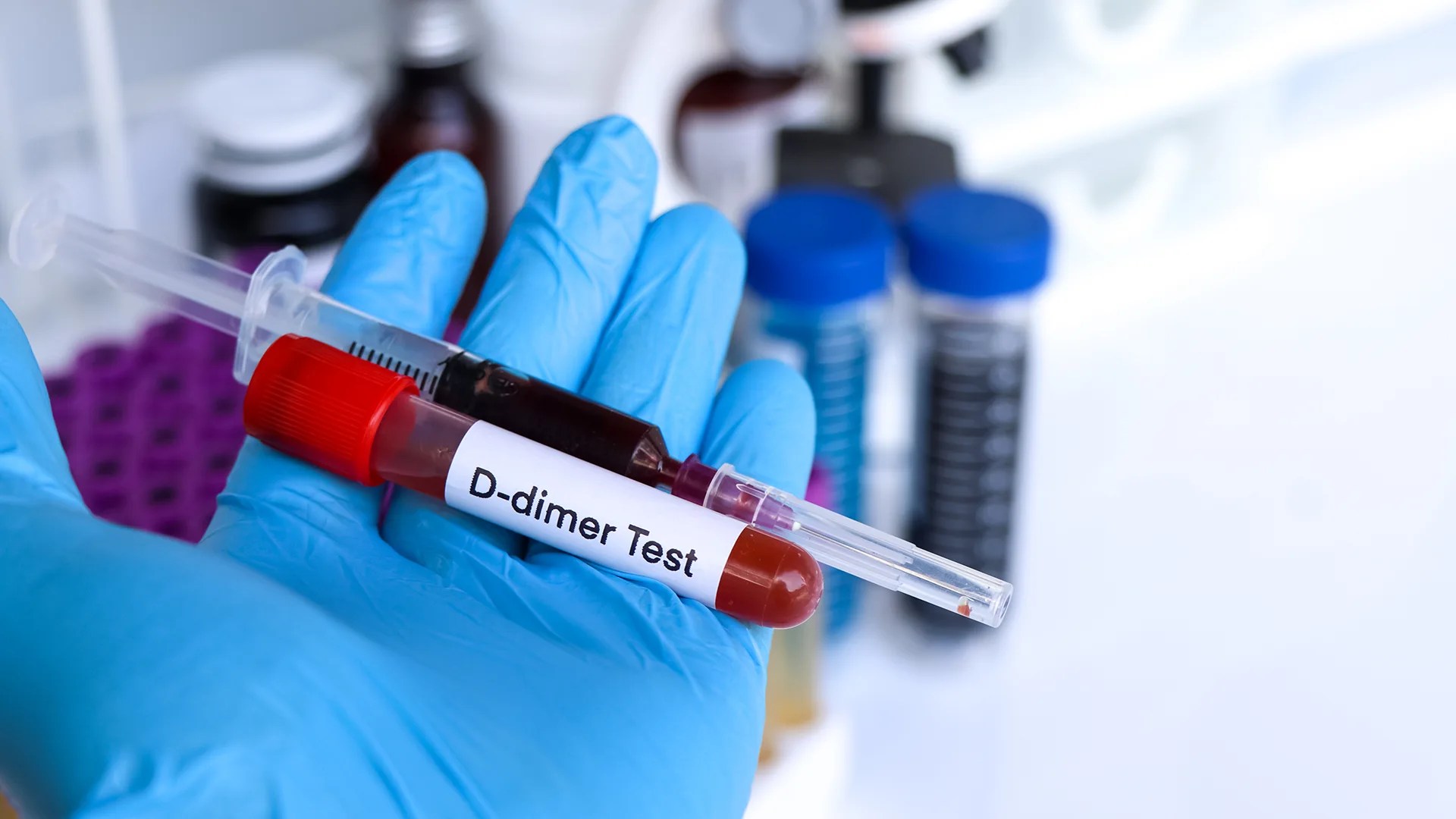 Ddimer i njegova uloga u dijagnostici tromboza Laboratorije