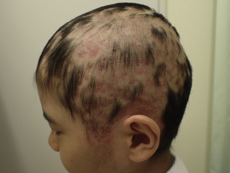 Kerion and tinea capitis MediHelp