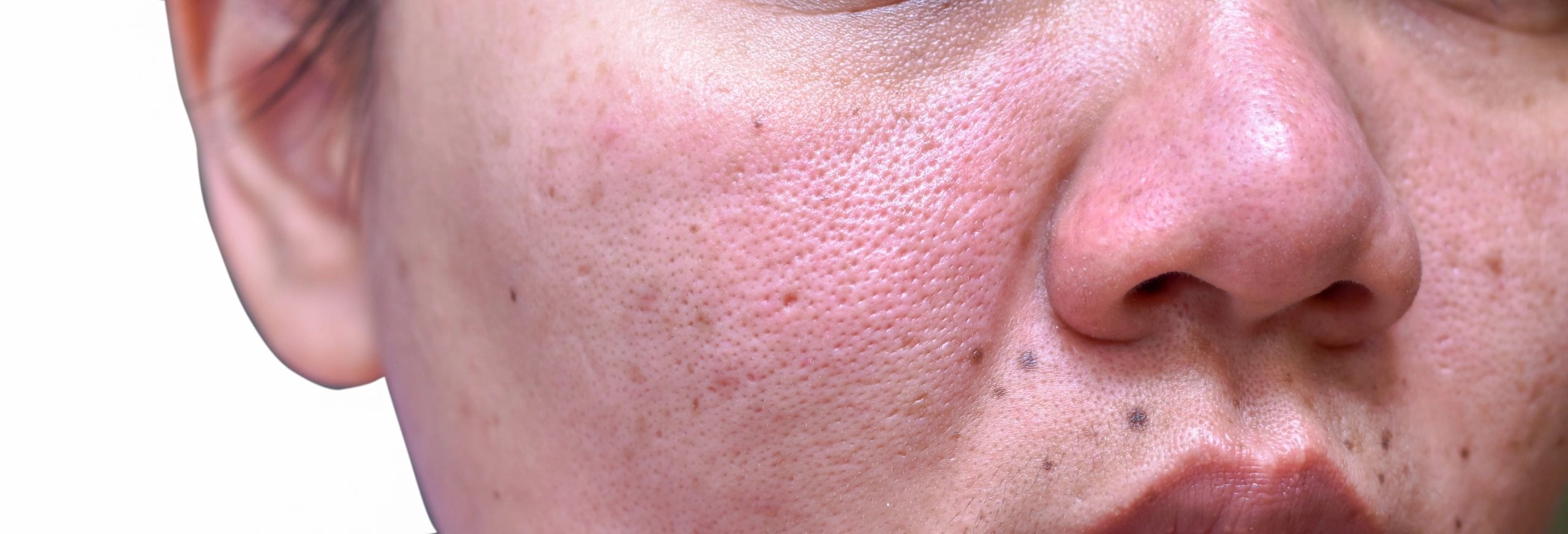 Anong Gamot Sa Sakit Na Lupus