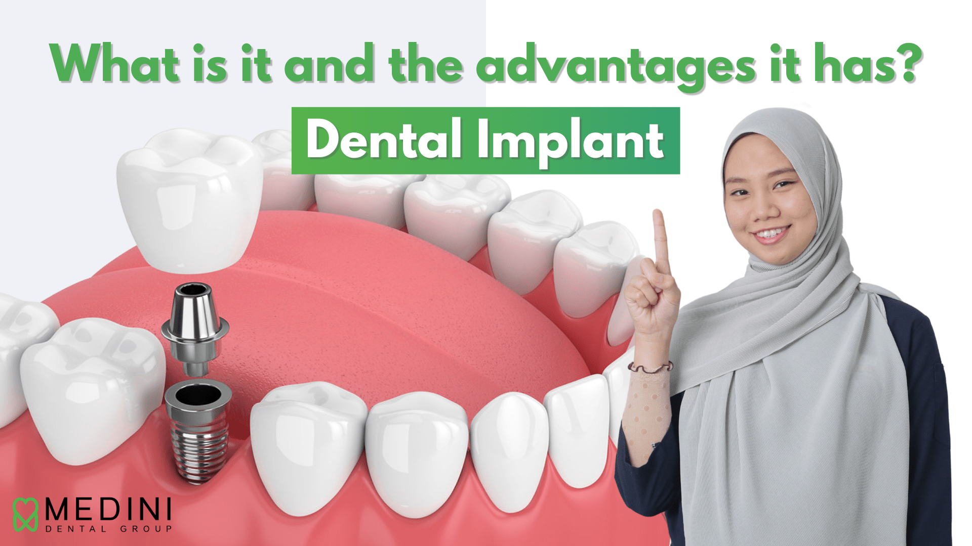 Dental Implant What is it and the advantages it has?