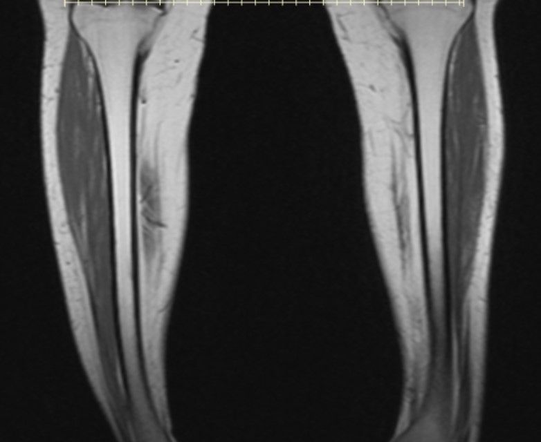 MRI Tibia/Fibula Mediphany