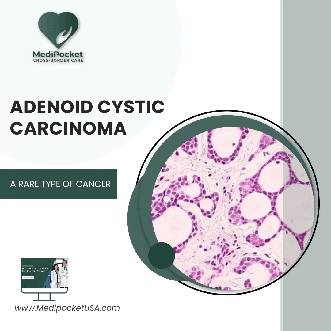 Adenoid Cystic Carcinoma Unraveling a Rare Disease