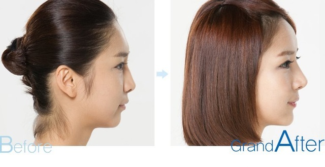 Can a flat forehead be fixed through plastic surgery?Medisetter
