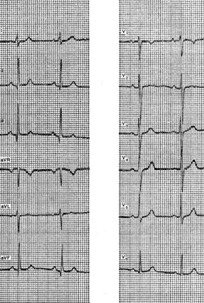 Поворот сердца правым желудочком вперед