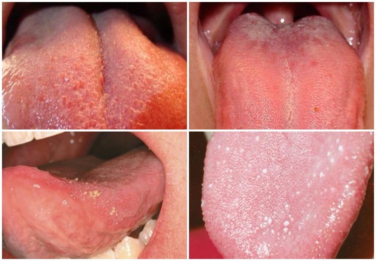 How to get rid of swollen taste buds?