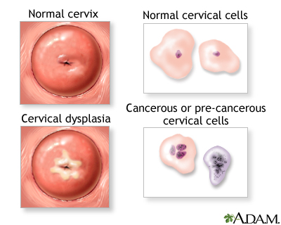 Cervical neoplasia MedlinePlus Medical Encyclopedia Image