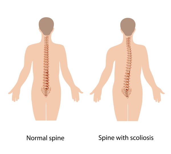 Adolescent idiopathic scoliosis MedlinePlus