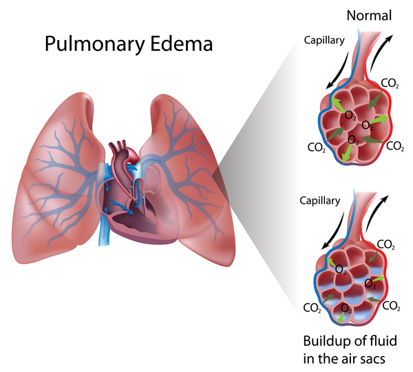 Pulmonary venoocclusive disease MedlinePlus