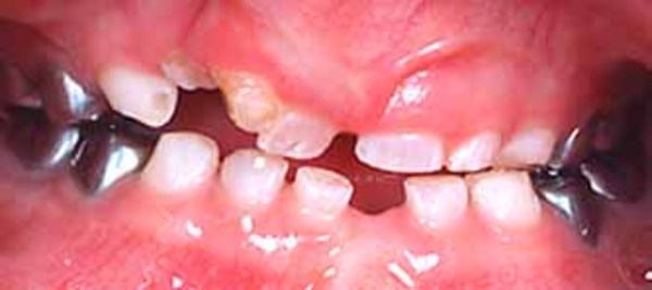 AxenfeldRieger syndrome MedlinePlus