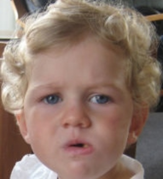 Retinoblastoma MedlinePlus