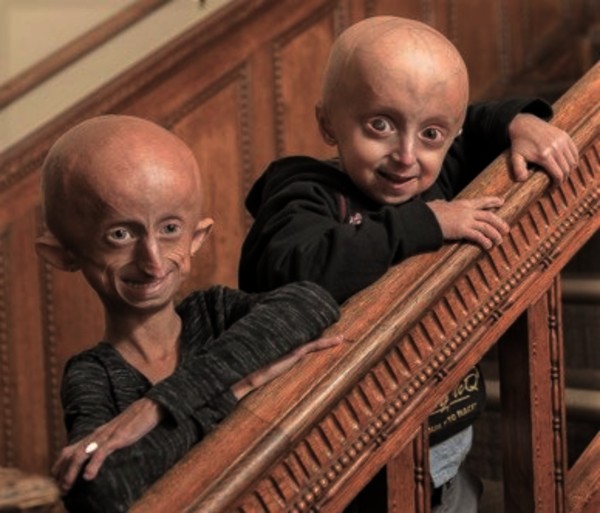 HutchinsonGilford progeria syndrome MedlinePlus