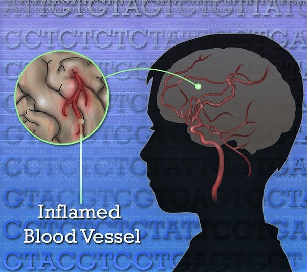 HutchinsonGilford progeria syndrome MedlinePlus