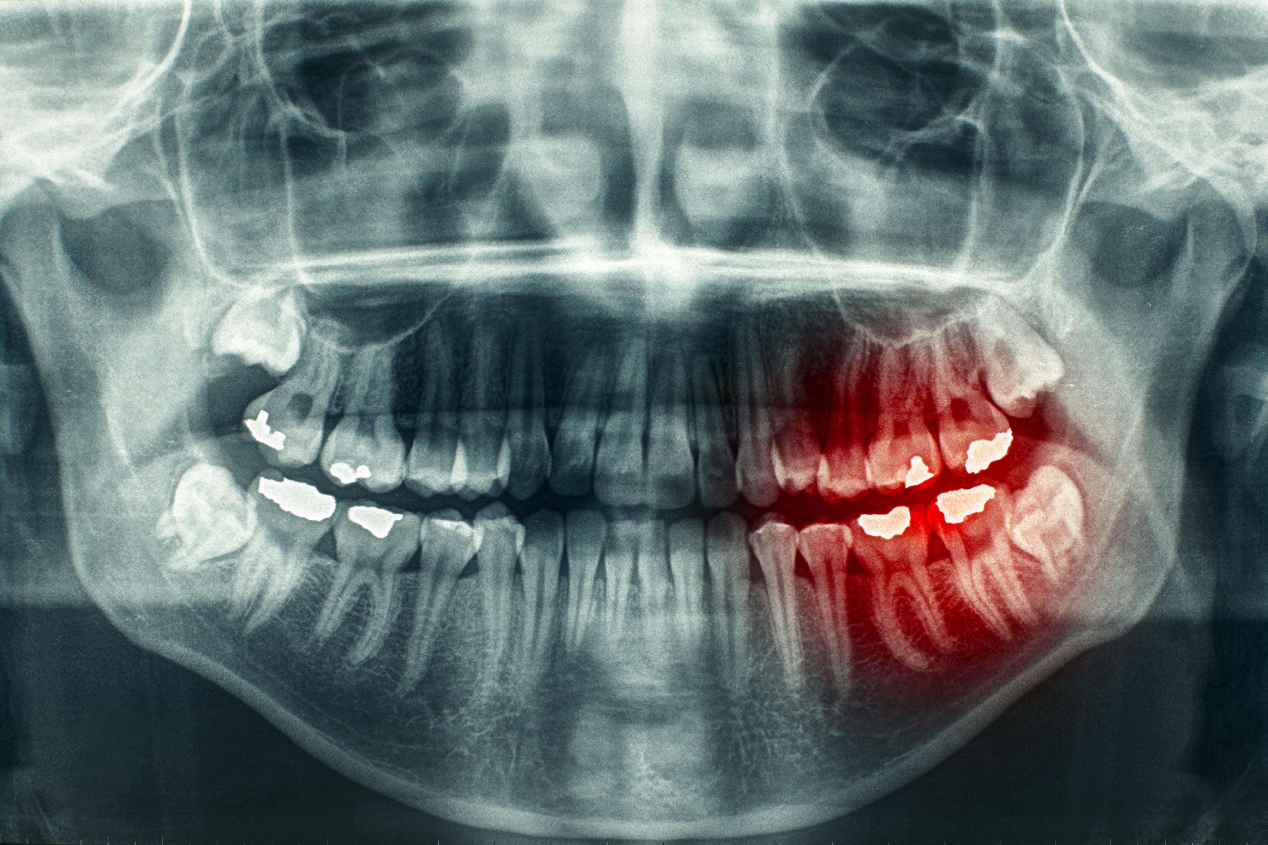 Tooth Disorders MedlinePlus