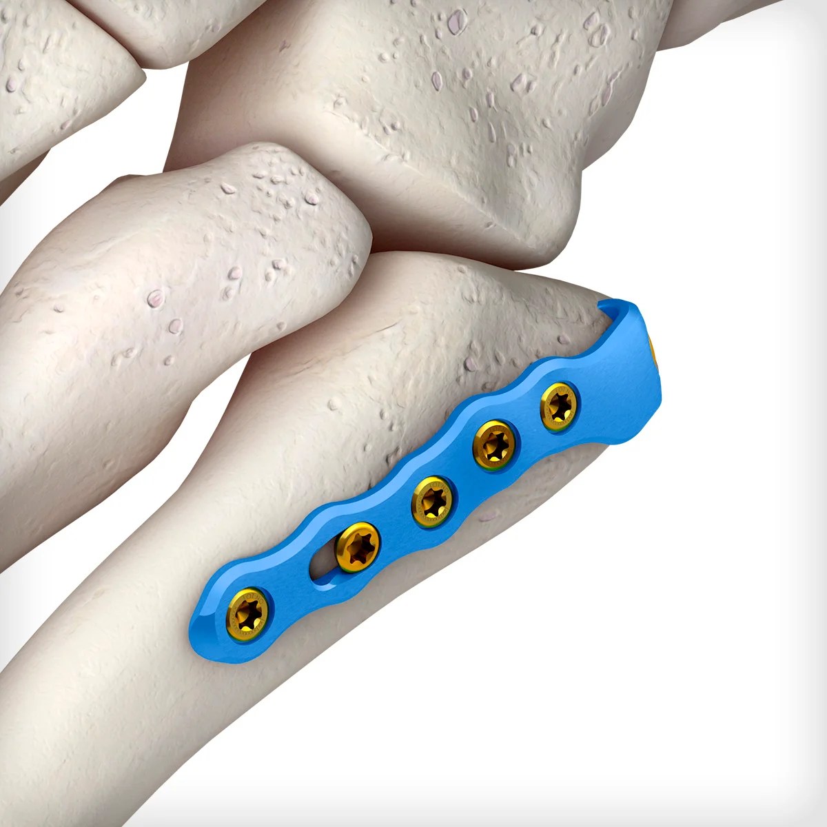 5th Metatarsal Hook Plates Unite Foot and Ankle