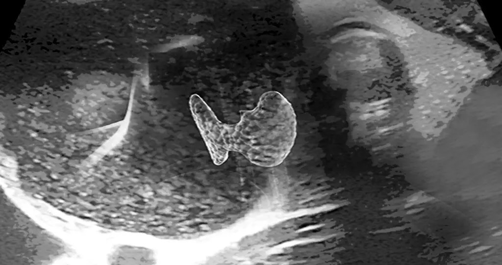 Schilddrüsenknoten mit Radiofrequenzablation behandeln