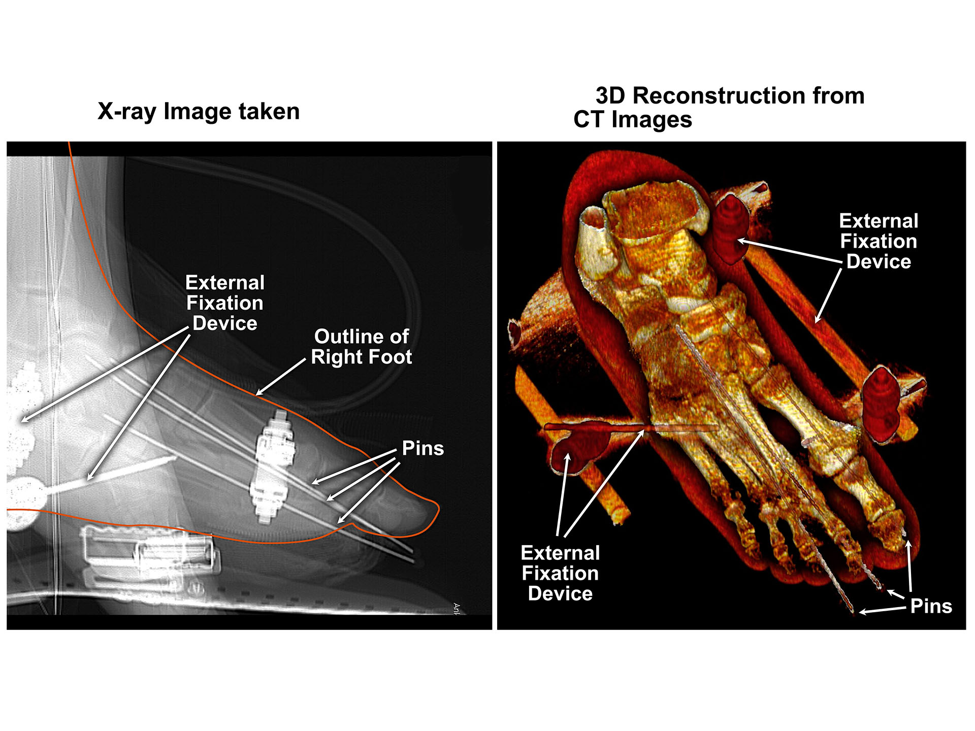 External Fixation of Foot Fractures