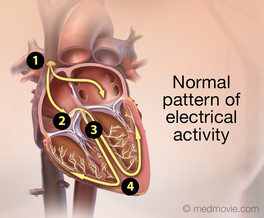 Catheter Ablation