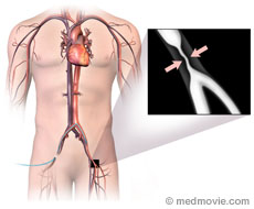 Mesenteric Artery Stent