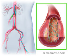 Mesenteric Artery Stent