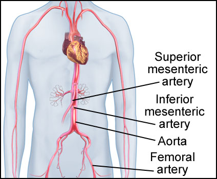 Mesenteric Artery Stent
