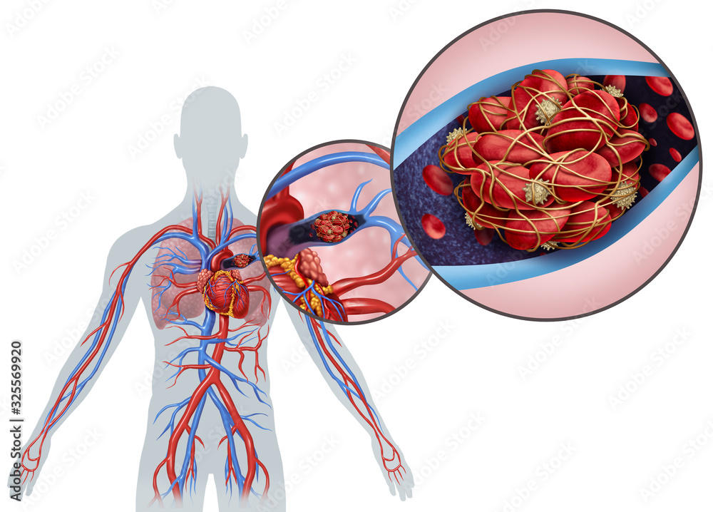 Why Are Blood Clots Dangerous? The essentials
