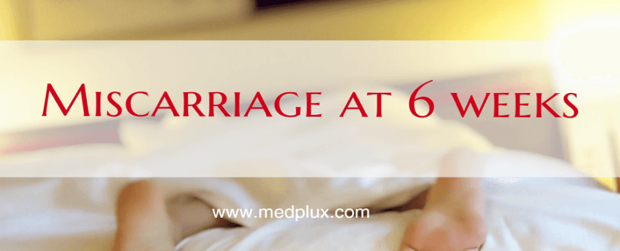 Miscarriage at 6 weeks Pregnant Signs, symptoms, Causes, Risks, Rates