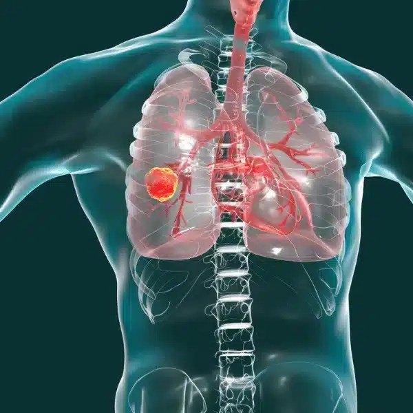 The Importance of Needle in Tactical Medicine