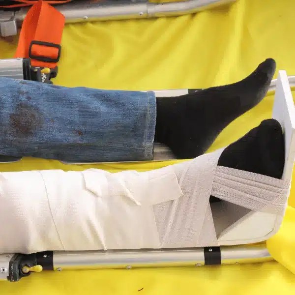 Splints in Emergency Situations Different Types and Uses