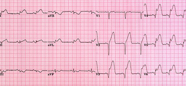 Acute anterolateral MI