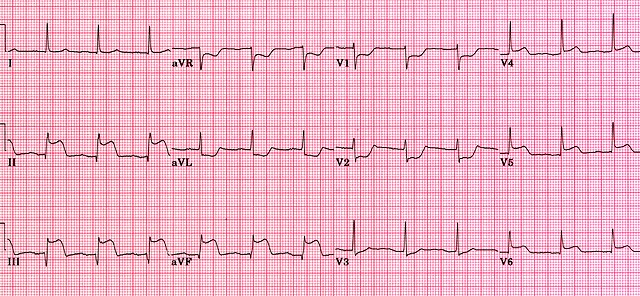 Acute inferior MI
