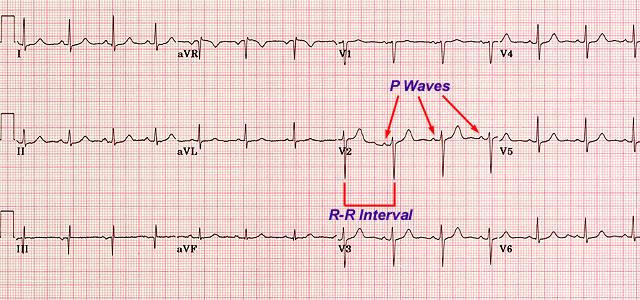 Step 4 Evaluate the cardiac rhythm