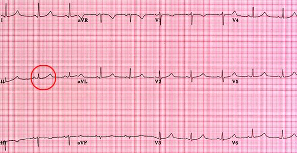 Step 10 Measure QT interval for specific diagnoses