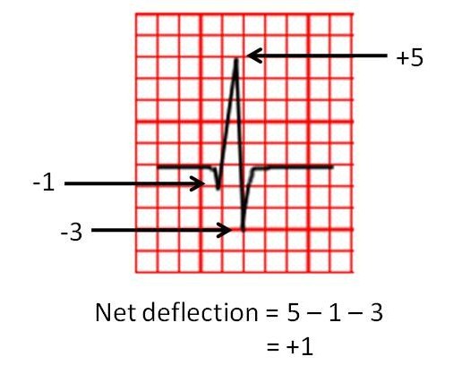 Step 3b Calculate the electrical axis