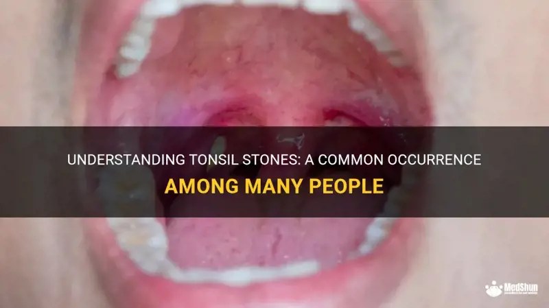 Understanding Tonsil Stones: A Common Occurrence Among Many People