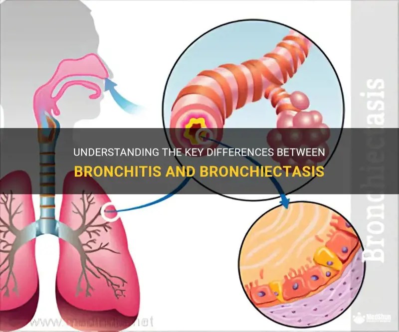 Understanding The Key Differences Between Bronchitis And Bronchiectasis MedShun